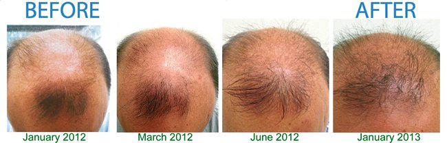 Before and After Hair Care by Organic Rosehip Skincare